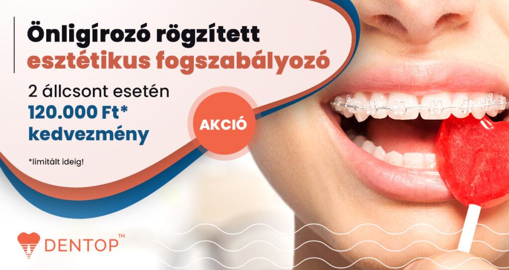 Önligírozó rögzített esztétikus fogszabályozó akció