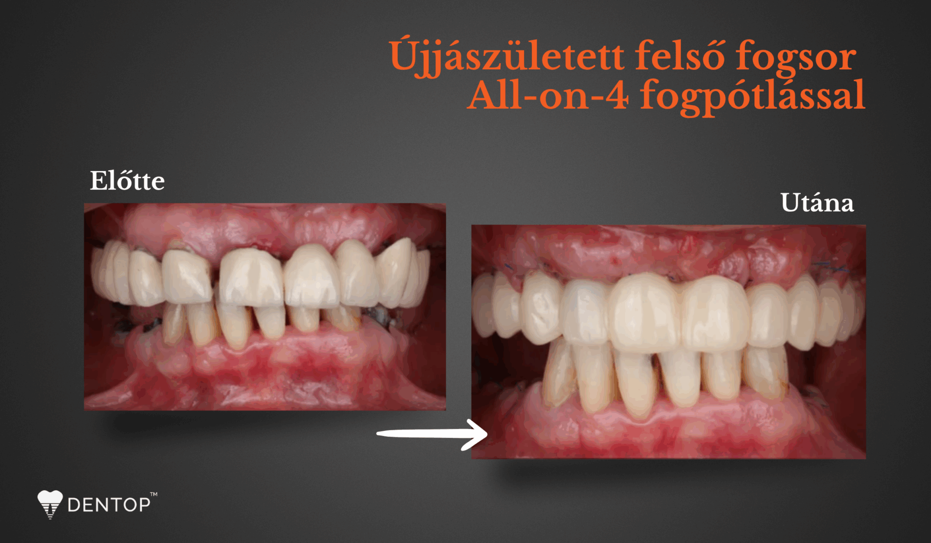 All-on-4 fogpótlás kezelés előtt és utáni állapotok
