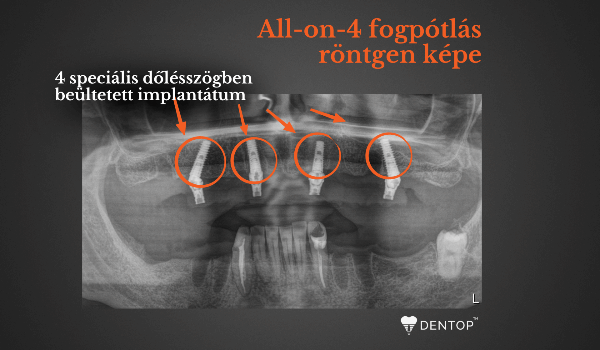 All-on-4 fogpótlás röntgen képen