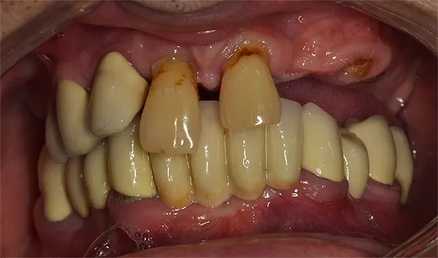 Implantátumra stéges fogpótlás