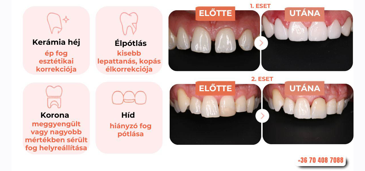 Kerámia héj élpótlásra