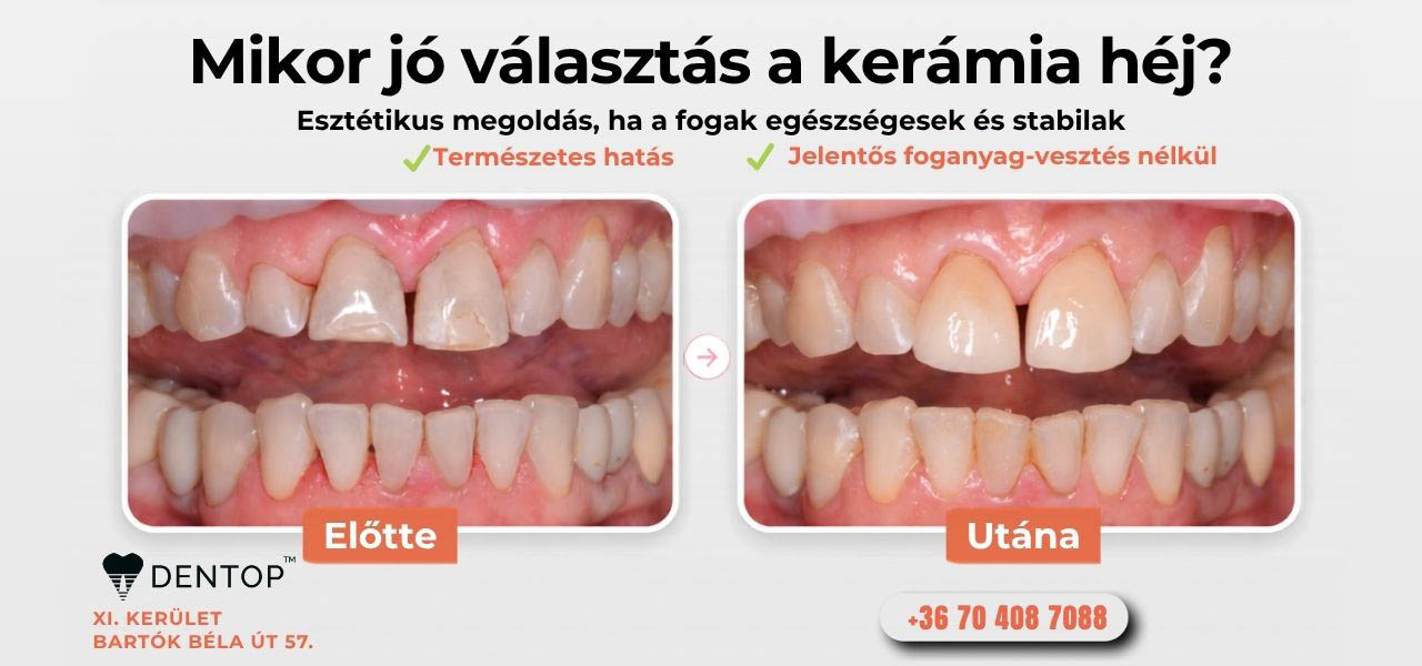 Mikor jó választás a kerámia héj?