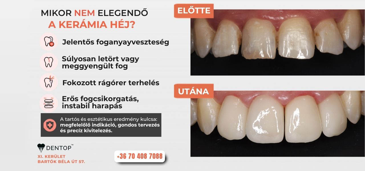 Mikor nem elegendő a kerámia héj?
