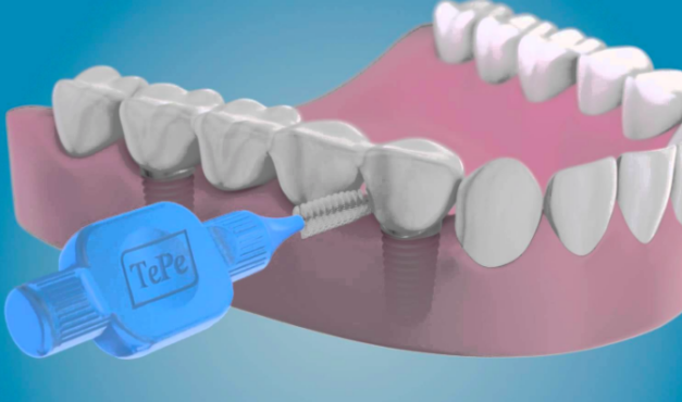 Az implantátum tisztítása fogköztisztítóval