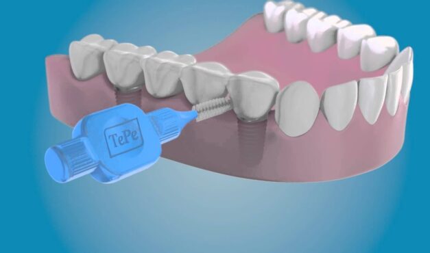 Implantátumos fogpótlás tisztítása fogköztisztítóval.