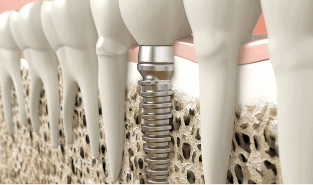 Fogimplantátum beépülése a csontállományba. Lehet-e implantátumom, ha nincs elég csontom?
