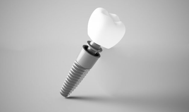 Fogimplantátum. Kilökődhet-e egy fogászati implantátum?